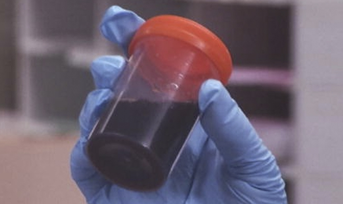Salvador tem 22 casos de doença misteriosa que causa urina preta