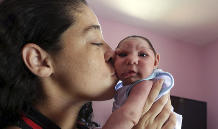 Brasil confirmou 165 casos de bebês com microcefalia e outras alterações ligadas à zika