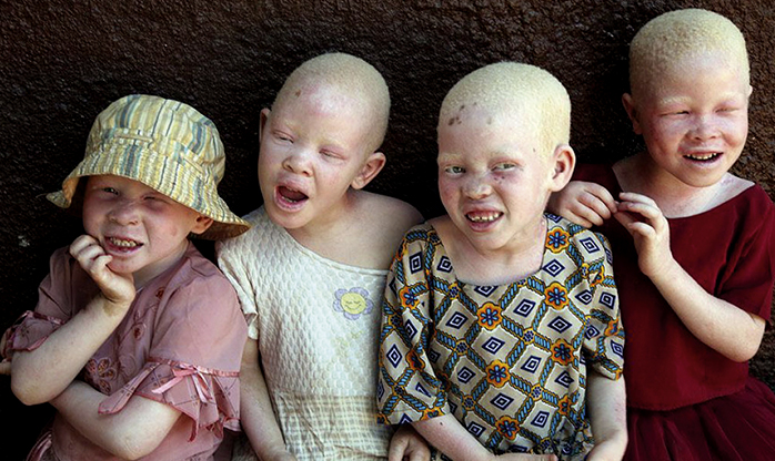 A triste realidade dos albinos na Tanzânia