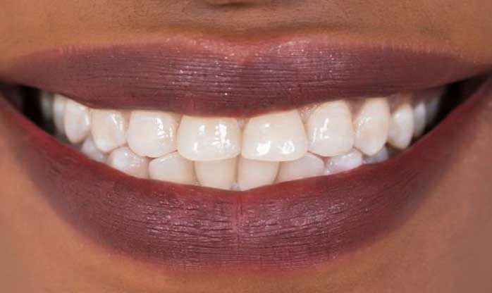 Cientistas britânicos criam substância que pode regenerar dentes e aposentar obturações